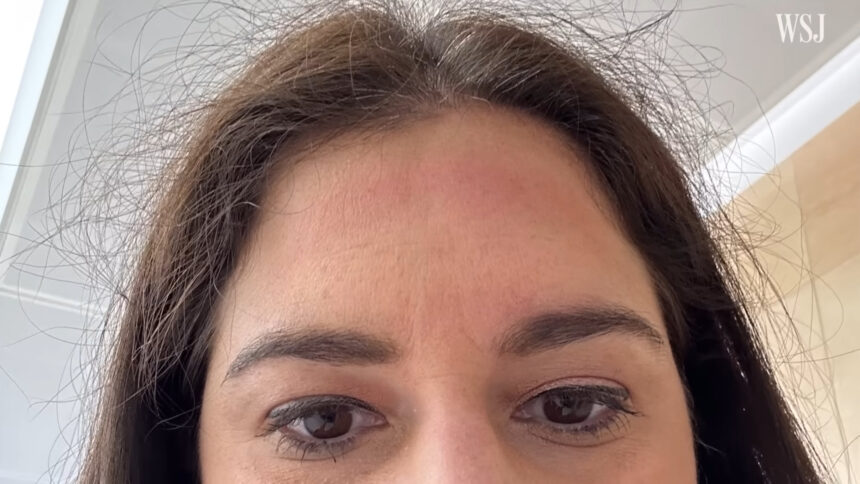 Red marks after wearing Apple Vision Pro for half an hour.